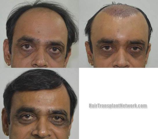 Before and after hair transplant procedure images