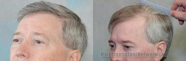 Left view hair transplant postoperative photos