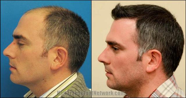 Hair restoration procedure before and after pictures