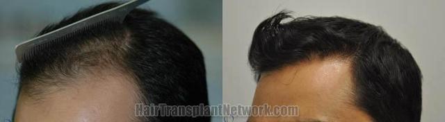 Hair restoration procedure before and after pictures