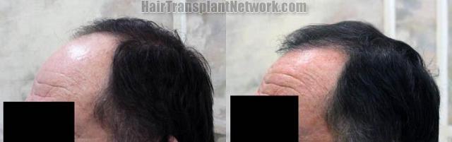 Hair transplantation surgery before and after pictures