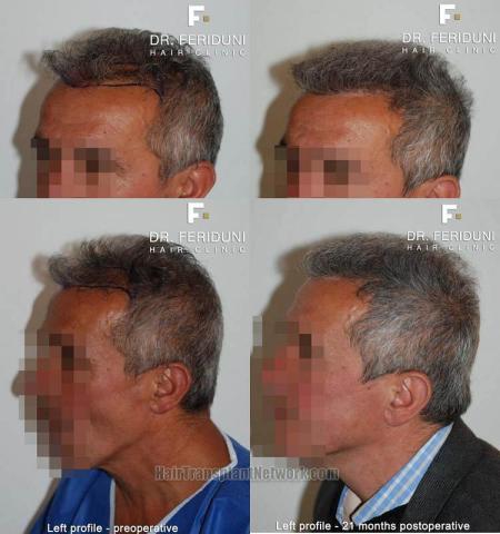 Hair transplantation surgery before and after pictures