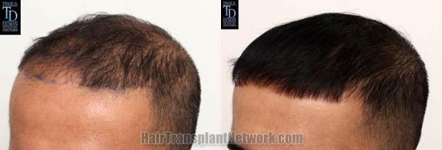 Hair transplantation surgery before and after images