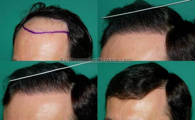 Hair transplantation surgery before and after images