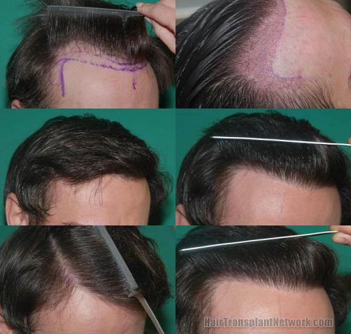 Hair transplantation surgery before and after photos