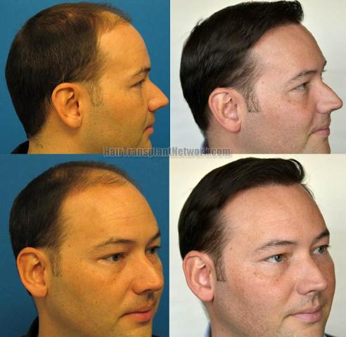 Hair transplantation surgery before and after images