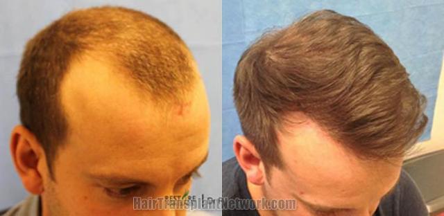 Hair transplantation surgery before and after pictures