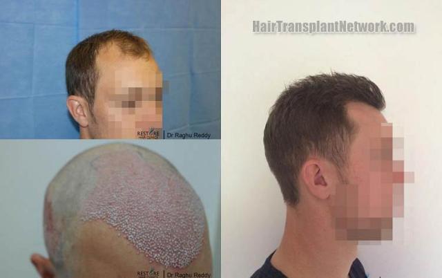 Hair restoration procedure before and after pictures