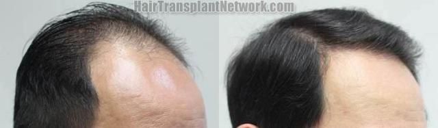 Hair transplantation surgery before and after pictures