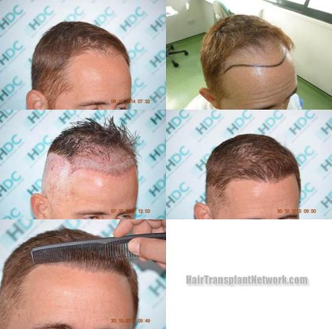 Hair transplantation surgery before and after photos