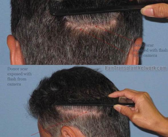 Hair restoration procedure before and after pictures