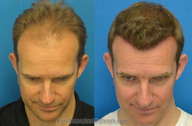 Hair restoration surgery before and after photos