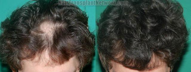 Hair restoration procedure before and after pictures