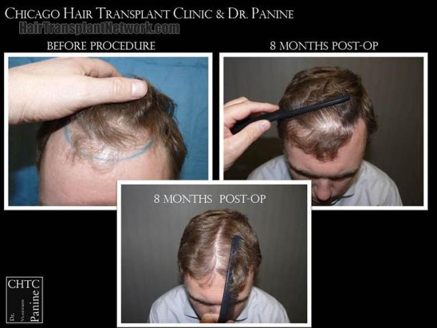 Hair transplantation surgery before and after photos