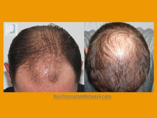 Hair transplantation surgery before and after photos