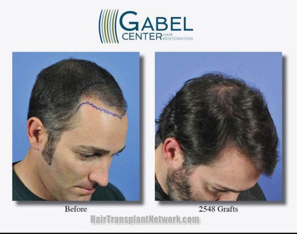 Hair restoration surgery before and after photos