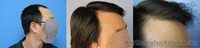 Right side views showing hair restoration results