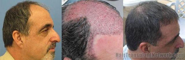 Right side patient results from hair transplant