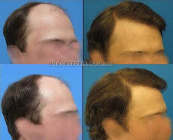 Hair restoration procedure before and after results