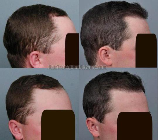 Hair transplantation surgery before and after pictures