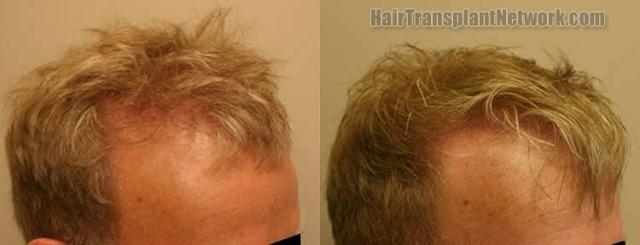 Hair transplantation surgery before and after photos