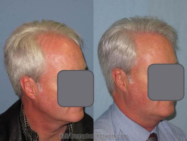 Hair transplantation surgery before and after photos