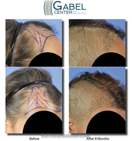 Hair restoration procedure before and after pictures