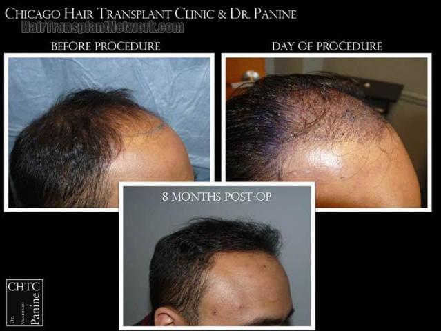 Hair restoration procedure before and after pictures