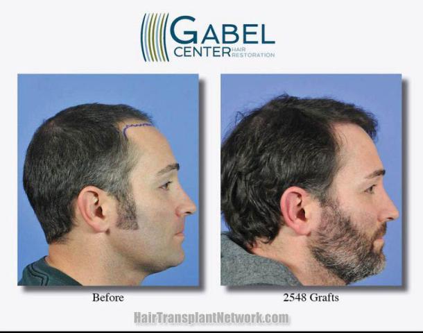 Hair transplantation surgery before and after images