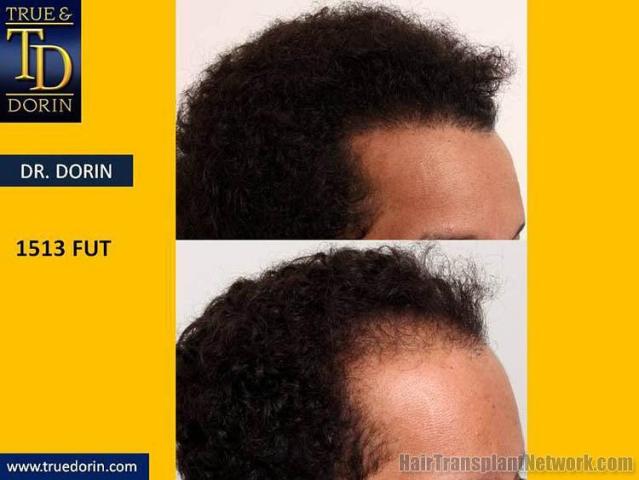 Hair restoration procedure before and after pictures