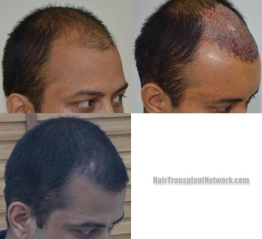 Hair transplantation surgery before and after photos