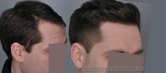 Hair transplantation surgery before and after photos