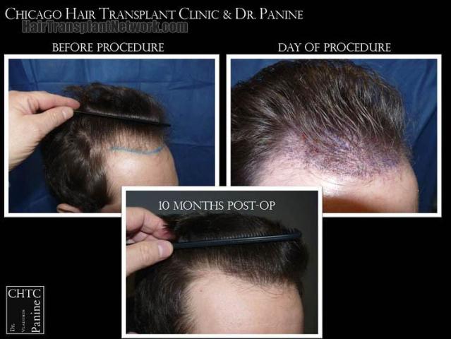 Hair transplantation surgery before and after images