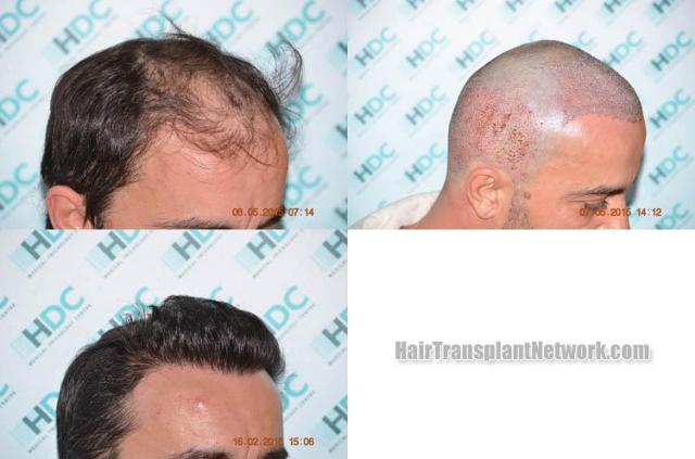 Hair transplantation surgery before and after photos