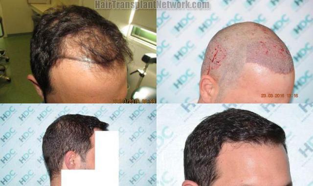 Hair restoration procedure before and after results