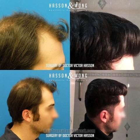 Hair transplantation surgery before and after images