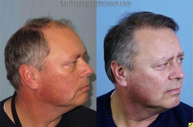 Hair restoration procedure before and after results