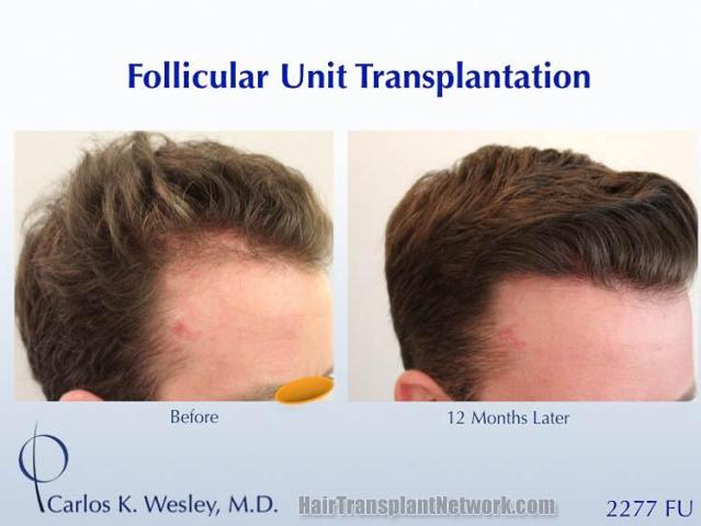 Hair transplantation surgery before and after images