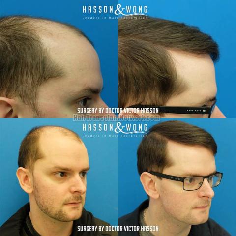 Hair restoration procedure before and after results