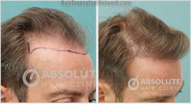 Hair restoration procedure before and after results