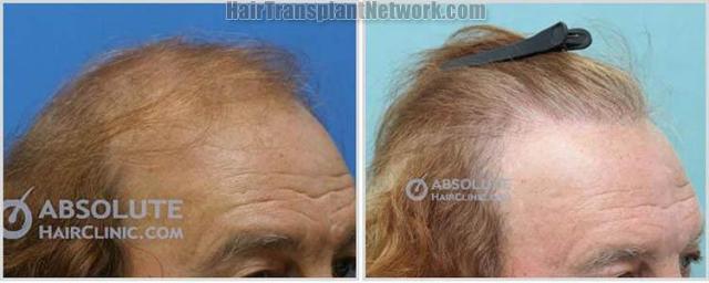 Hair restoration procedure before and after results