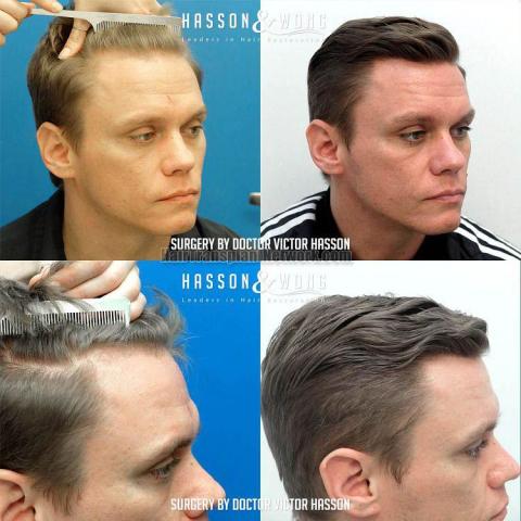 Hair transplantation procedure before and after results