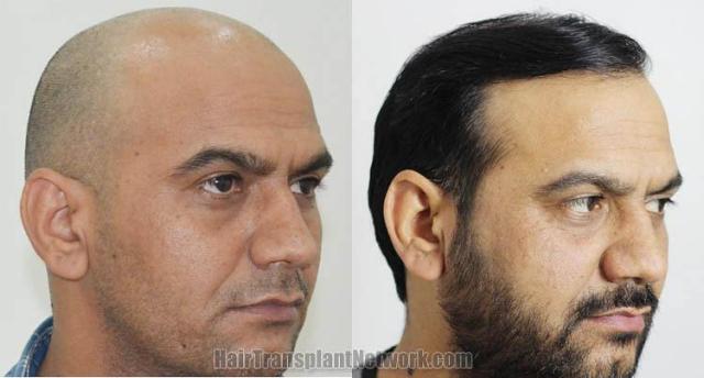 Hair transplantation procedure before and after results