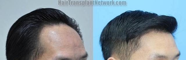 Hair restoration procedure before and after result images