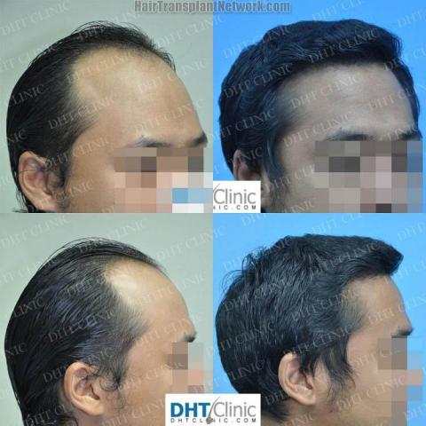 Hair transplantation procedure before and after results