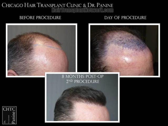 Hair transplantation procedure before and after results