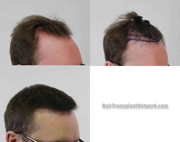 Hair restoration procedure after result images