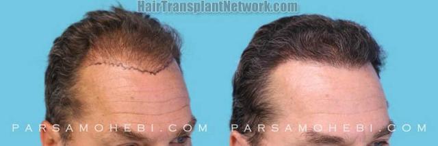 Hair transplantation surgery before and after images