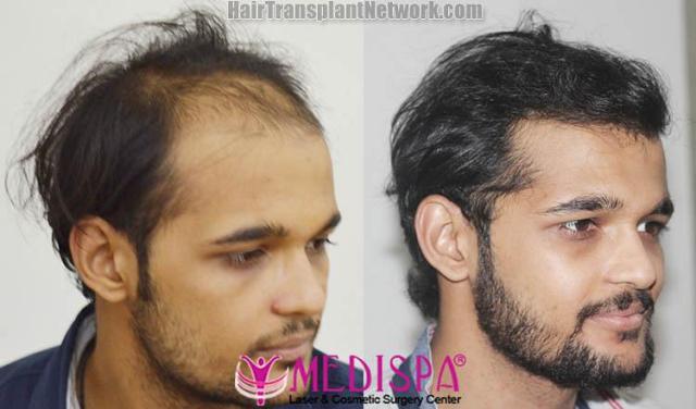 Hair transplantation procedure before and after results