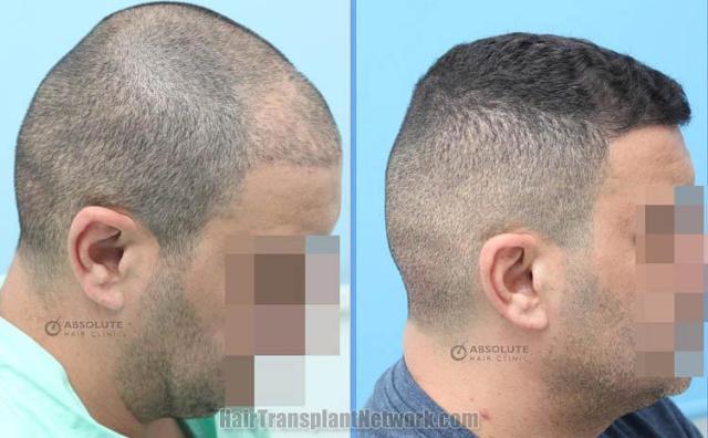 Hair transplantation procedure before and after results